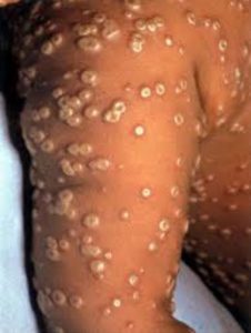 smallpox